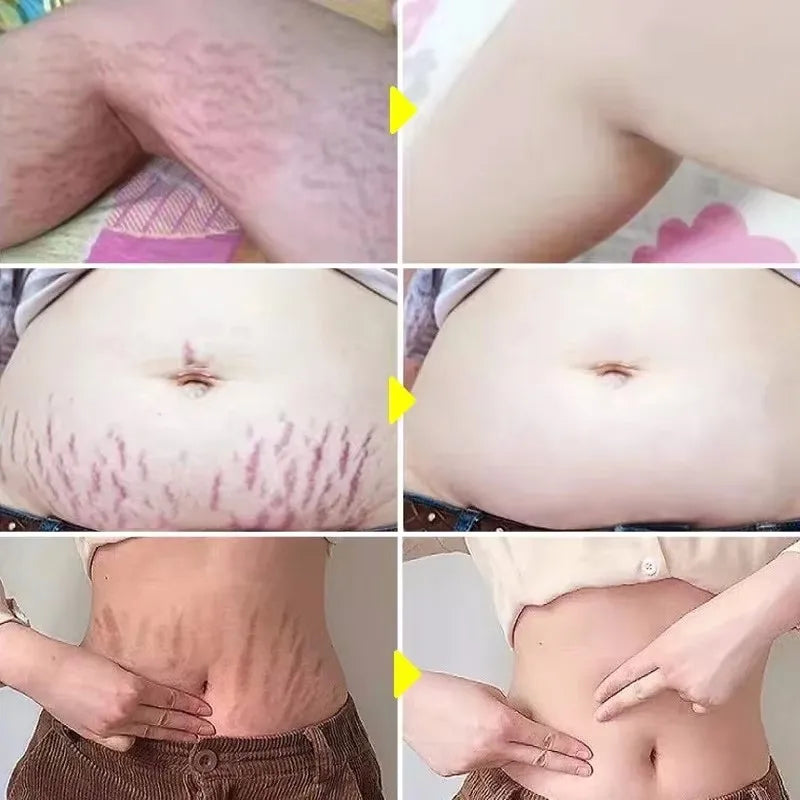 "SOIN" Huile essentielle, grossesse pour corps, nouveau  sérum d'élimination des vergetures, augmente l'élasticité de la peau